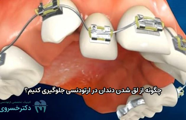 جلوگیری از لق شدن دندان