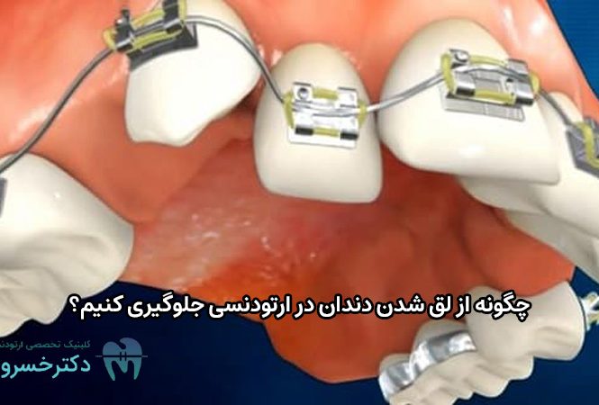 جلوگیری از لق شدن دندان