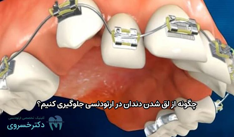 جلوگیری از لق شدن دندان