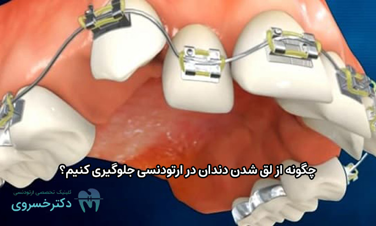 جلوگیری از لق شدن دندان