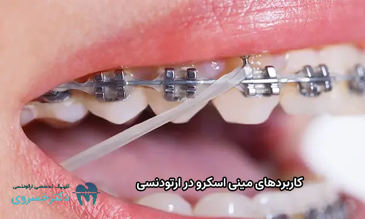 کاربردهای مینی اسکرو در ارتودنسی
