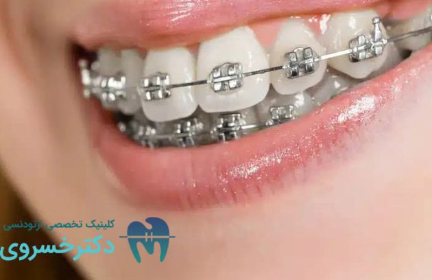 کراودینگ دندان