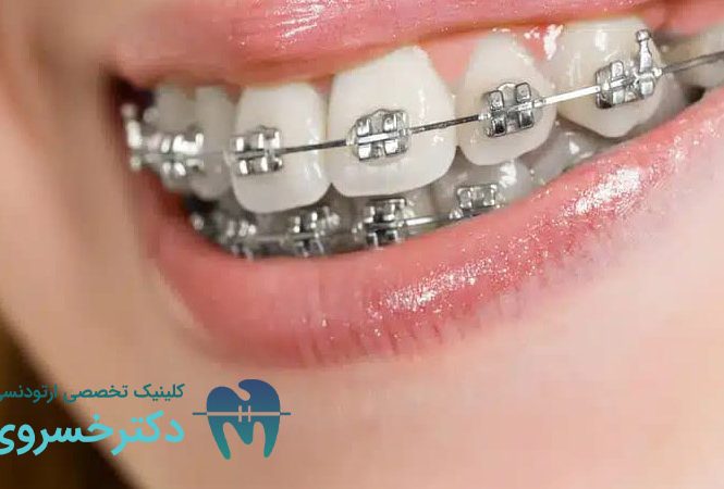 کراودینگ دندان