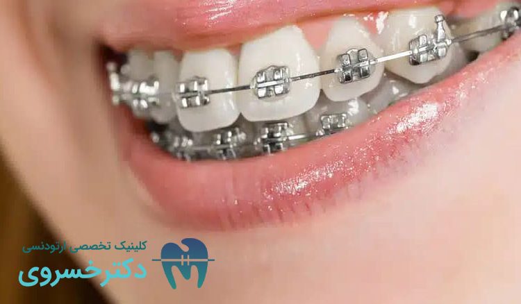 کراودینگ دندان