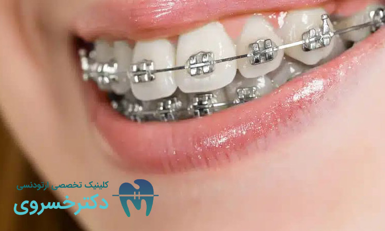 کراودینگ دندان