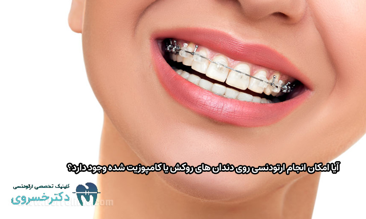 امکان انجام ارتودنسی روی دندان های روکش یا کامپوزیت شده