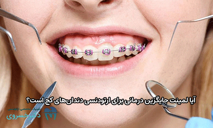 لمینت جایگزین درمانی برای ارتودنسی دندانهای کج