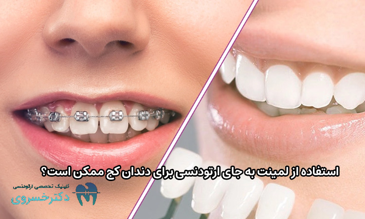 لمینت به جای ارتودنسی برای دندان کج