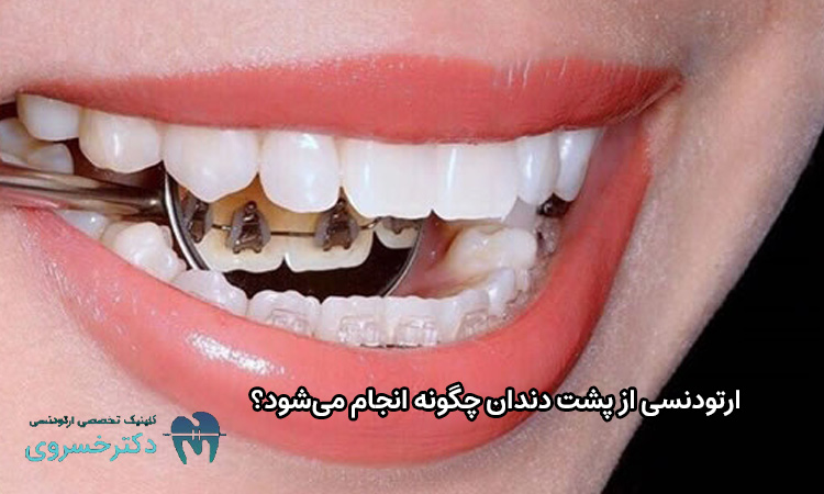 همه چیز درباره ارتودنسی لینگوال