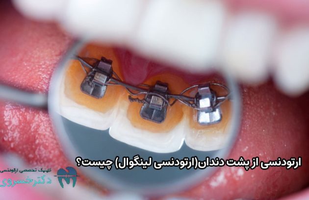 ارتودنسی از پشت دندان