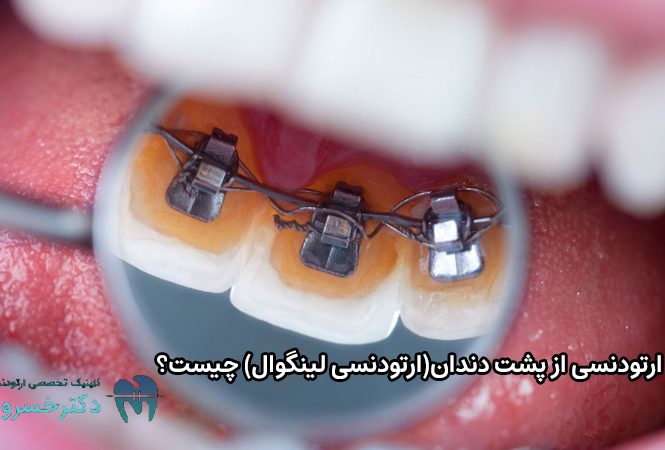 ارتودنسی از پشت دندان