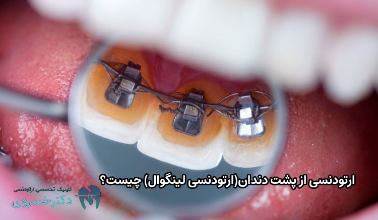 ارتودنسی از پشت دندان
