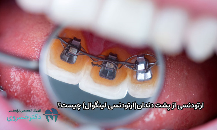 ارتودنسی از پشت دندان