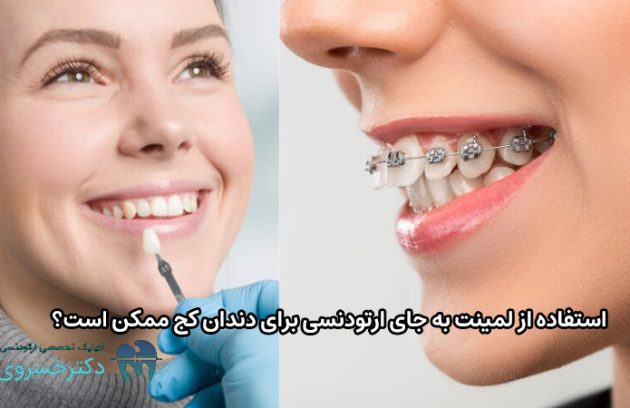 لمینت به جای ارتودنسی برای دندان کج