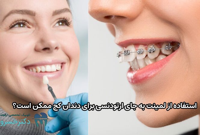 لمینت به جای ارتودنسی برای دندان کج