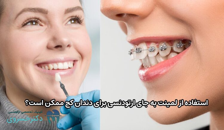 لمینت به جای ارتودنسی برای دندان کج