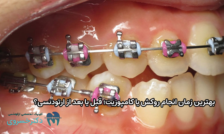 بهترین زمان انجام روکش یا کامپوزیت