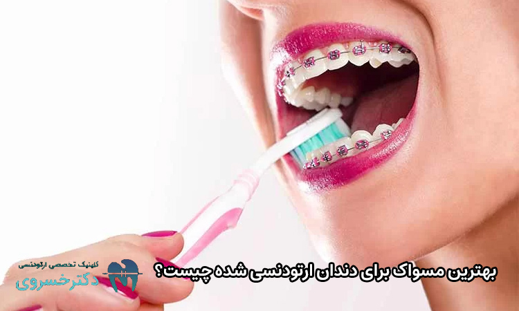 بهترین مسواک برای دندان ارتودنسی شده