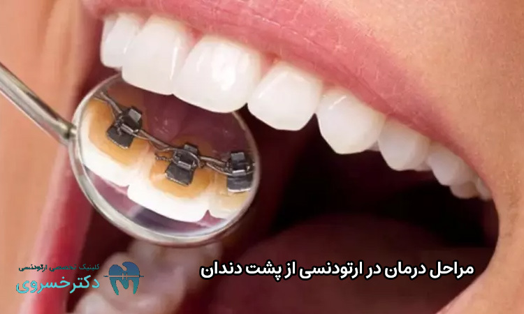 مراحل درمان ارتودنسی از پشت