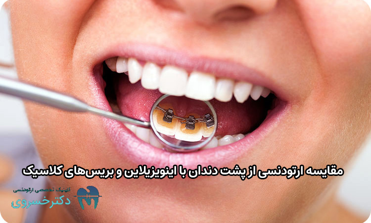 مقایسه ارتودنسی از پشت دندان با اینویزیلاین و بریس‌های کلاسیک