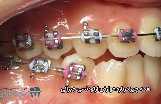 عوارض ارتودنسی جبرانی