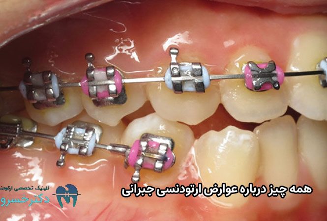 عوارض ارتودنسی جبرانی