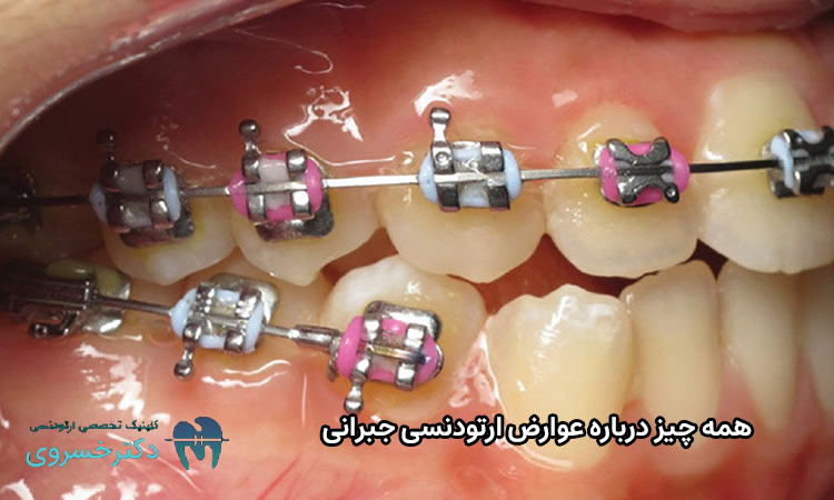 عوارض ارتودنسی جبرانی