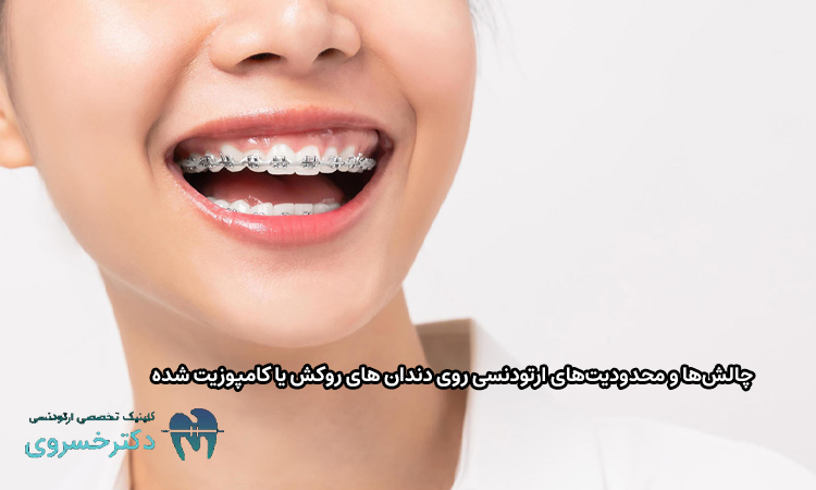 محدودیت‌های ارتودنسی روی دندان های روکش یا کامپوزیت