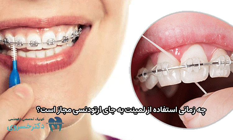 زمان استفاده از لمینت به جای ارتودنسی