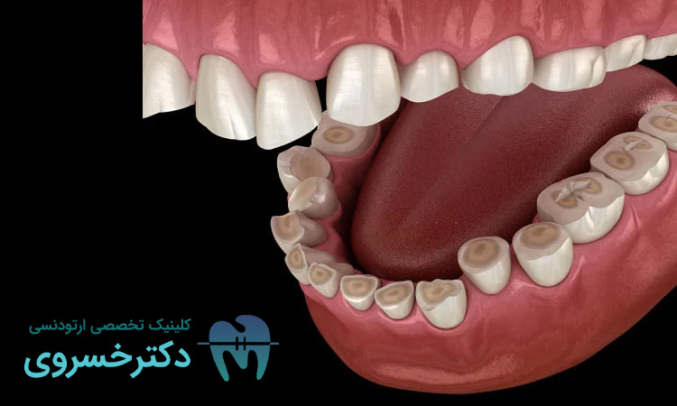علائم و عوارض دندان قروچه