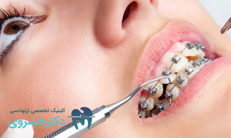 ارتودنسی در سن بالا