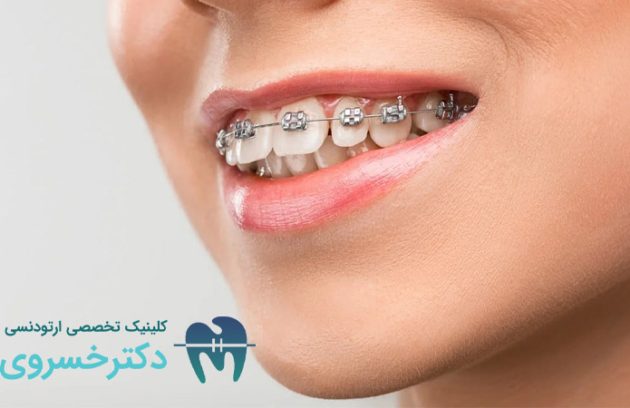 پوشش هزینه ارتودنسی با بیمه تکمیلی
