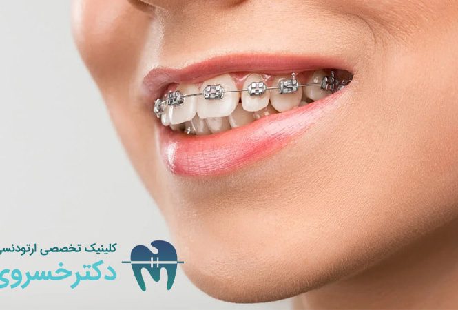 پوشش هزینه ارتودنسی با بیمه تکمیلی