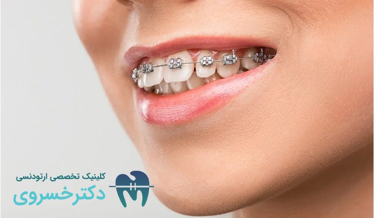 پوشش هزینه ارتودنسی با بیمه تکمیلی