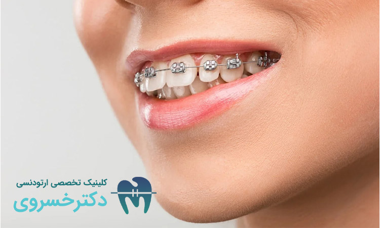 پوشش هزینه ارتودنسی با بیمه تکمیلی