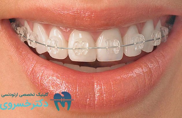 ارتودنسی دندان مناسب چه کسانی است؟