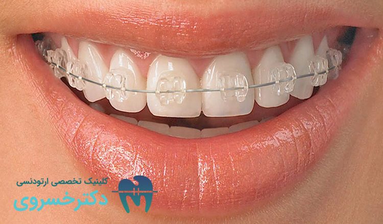 ارتودنسی دندان مناسب چه کسانی است؟