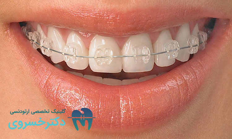 ارتودنسی دندان مناسب چه کسانی است؟