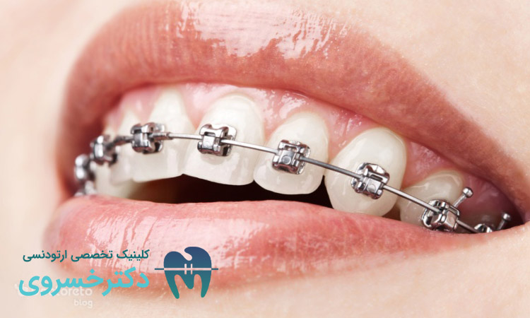 رفع مشکلات فکی با ارتودنسی دندان