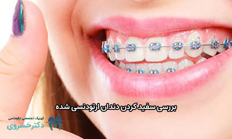 بررسی سفید کردن دندان ارتودنسی شده