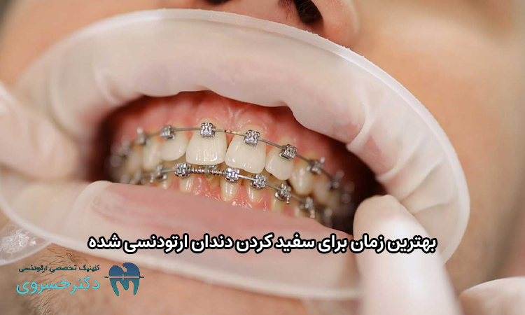 بهترین زمان برای سفید کردن دندان ارتودنسی شده