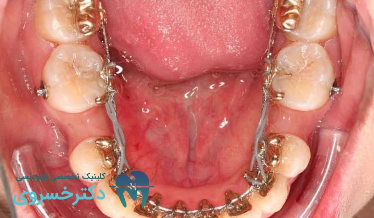 درمان مجدد ارتودنسی غلط