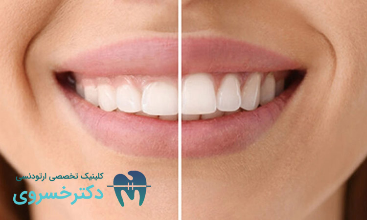 راه حل لبخند لثه ای