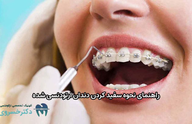 نحوه سفید کردن دندان ارتودنسی شده