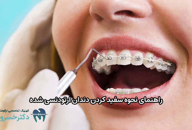 نحوه سفید کردن دندان ارتودنسی شده