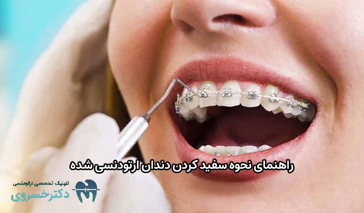 نحوه سفید کردن دندان ارتودنسی شده