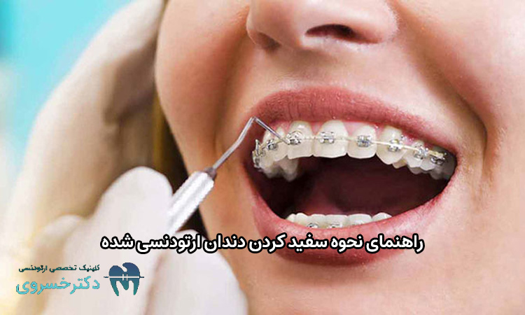 نحوه سفید کردن دندان ارتودنسی شده