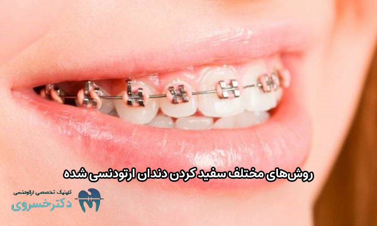 روش های مختلف سفید کردن دندان ارتودنسی شده