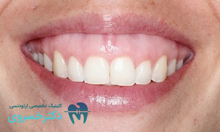 لبخند لثه ای