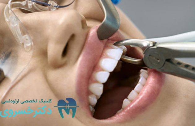 لزوم کشیدن دندان در ارتودنسی